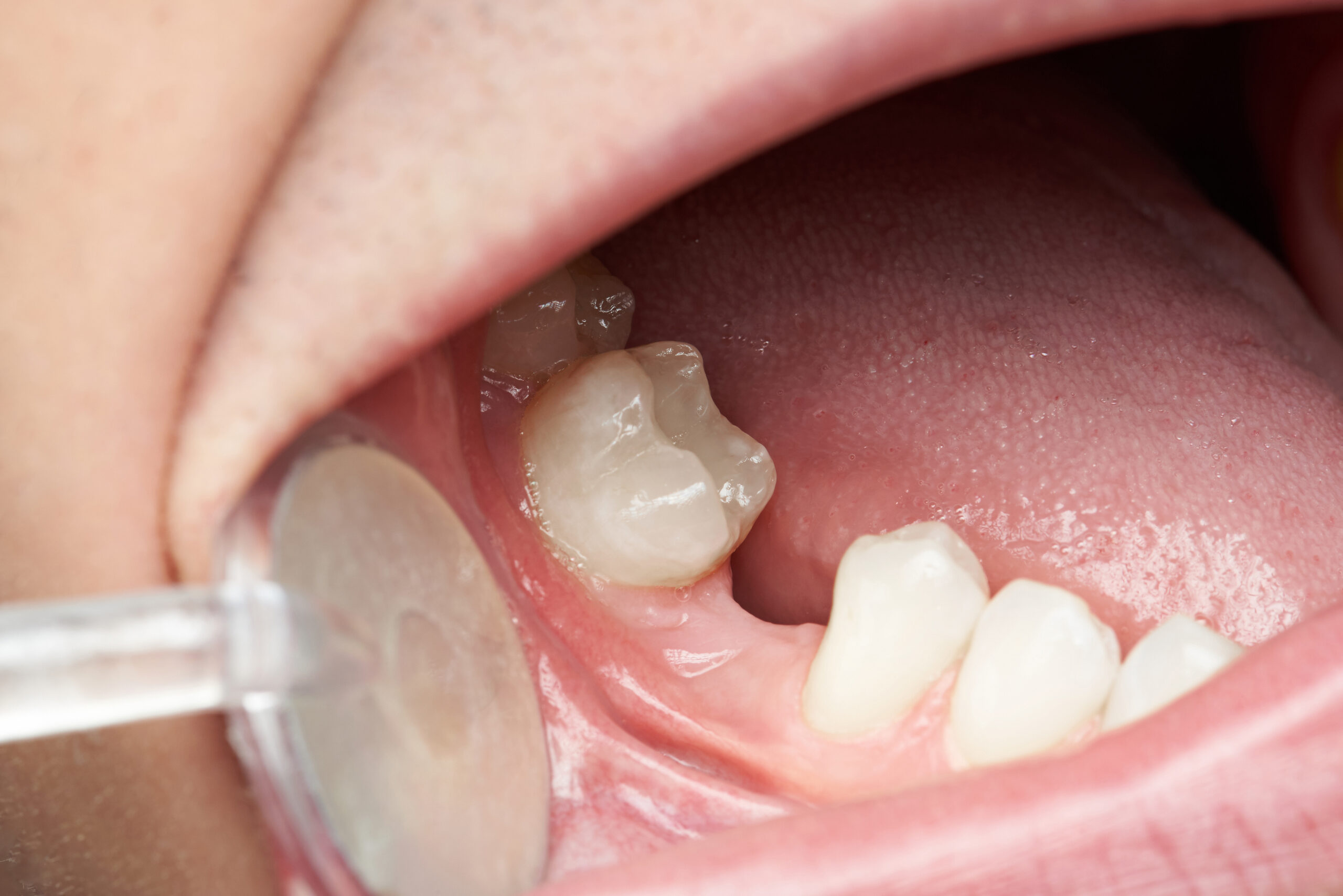 Missing Teeth