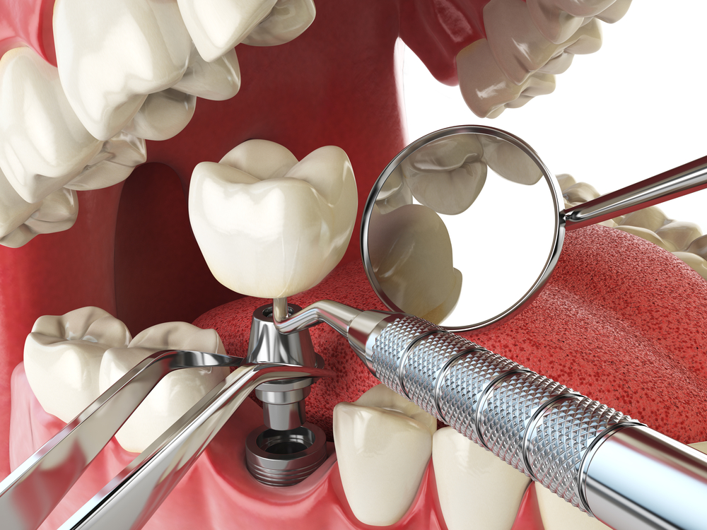Dental Implant Cost