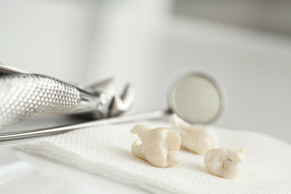 Wisdom Teeth: Issues and Extraction