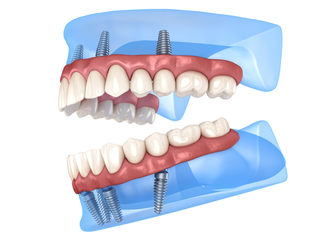 All_on_4_implants