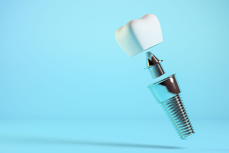 dental implant