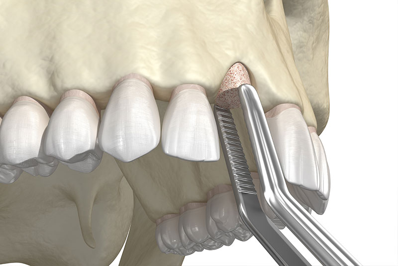 bone grafting
