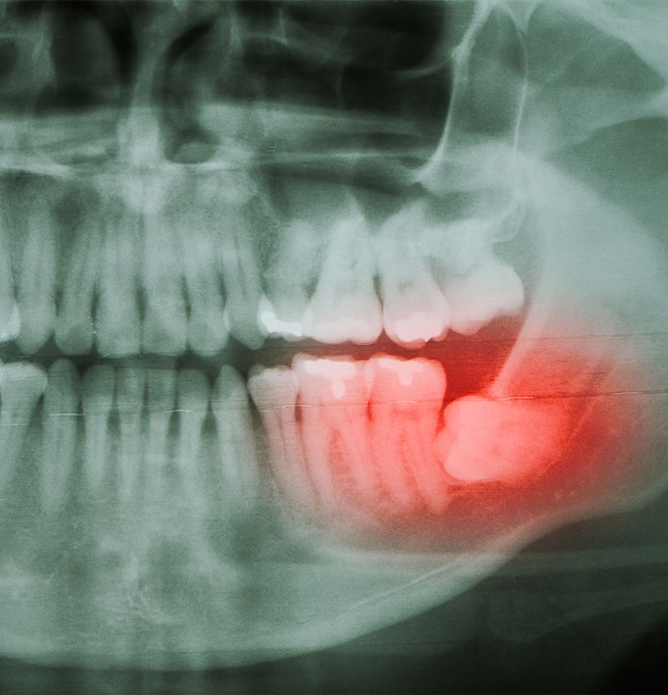wisdom tooth