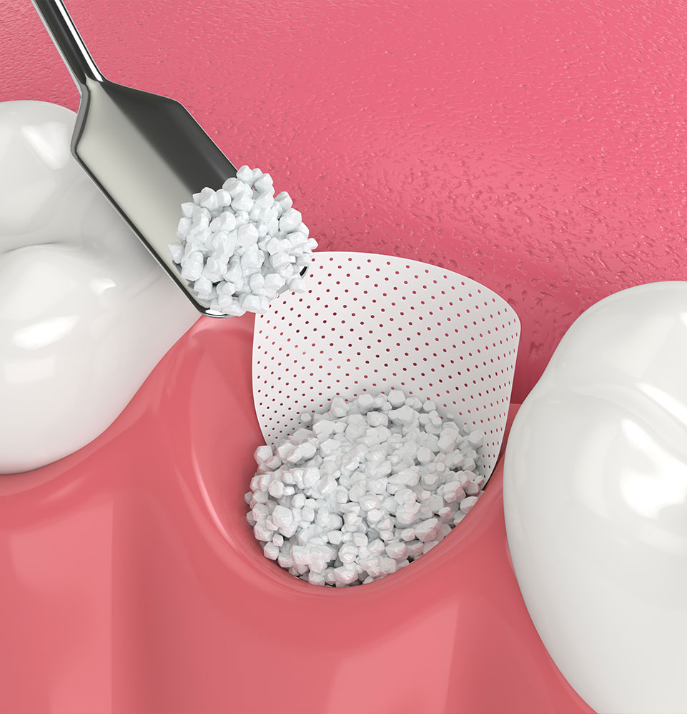 bone grafting