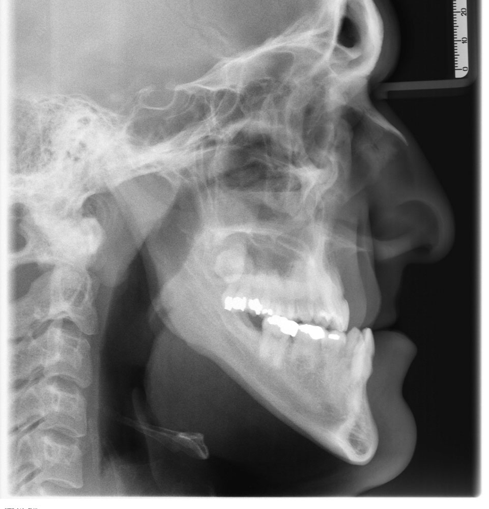 x-ray of misaligned jaw