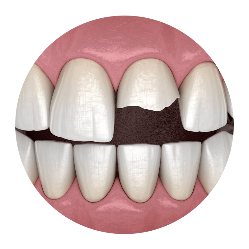 broken tooth