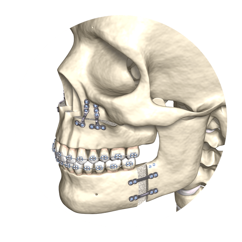 full mouth reconstruction