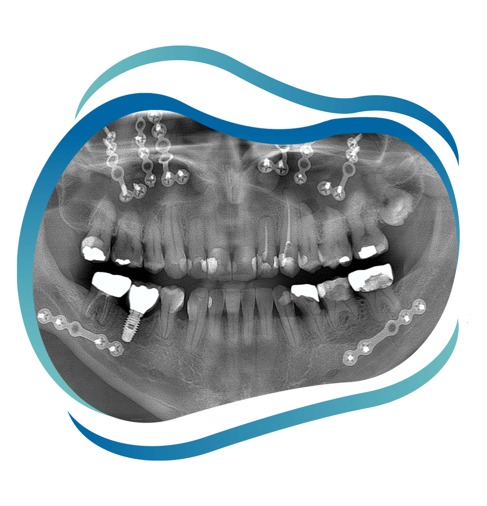 x-ray of jaw surgery