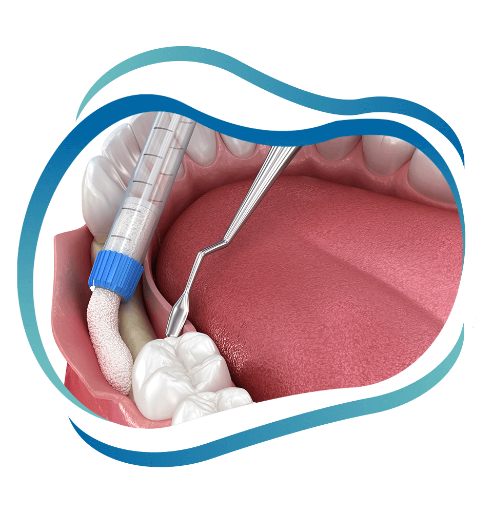 bone grafting