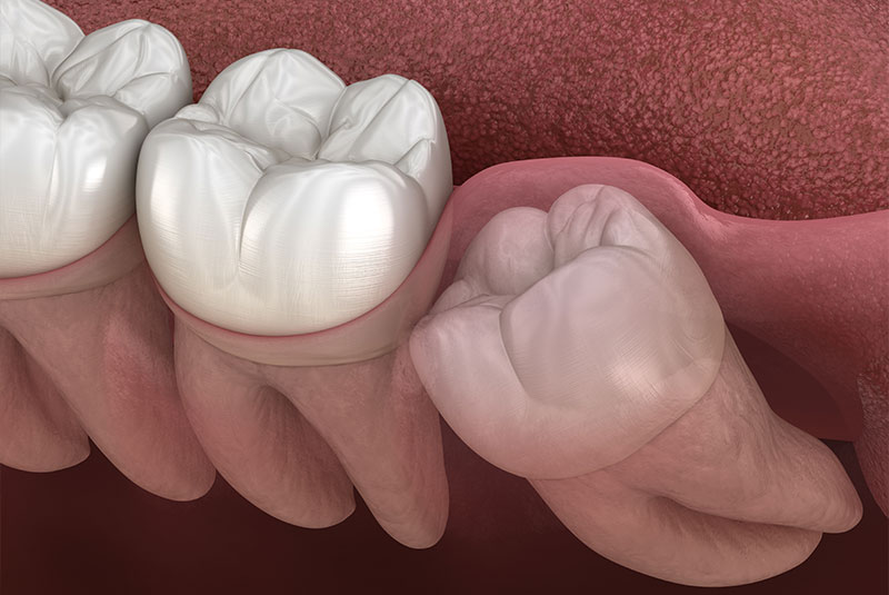 wisdom teeth